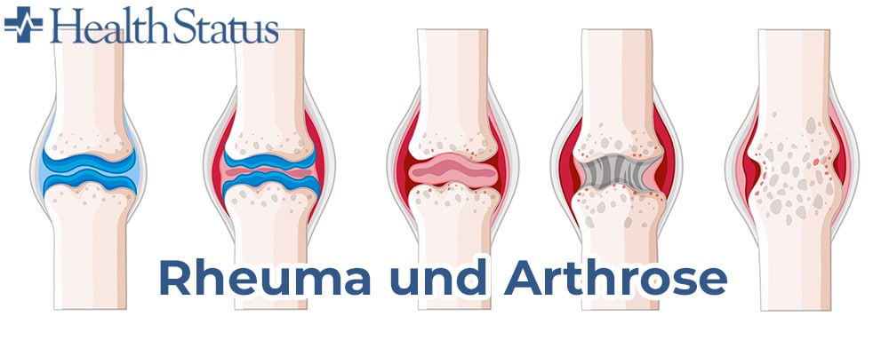 Rheuma und Arthrose