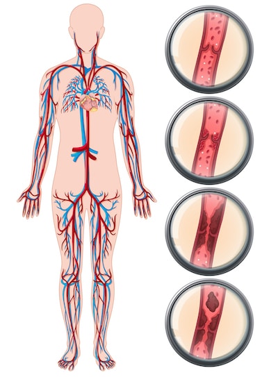 Revitive Thrombose