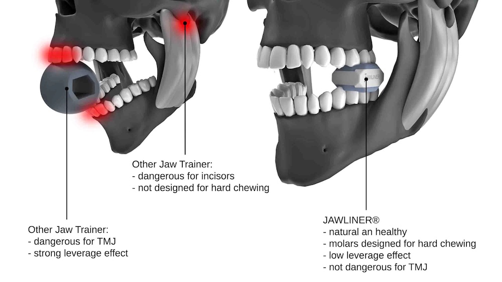 Jawliner Hilfe bei Kieferschmerzen