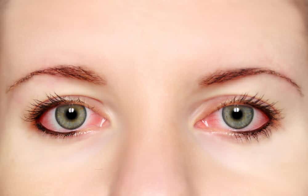 Pink Eye Complications and Treatment & Causes of pink eye