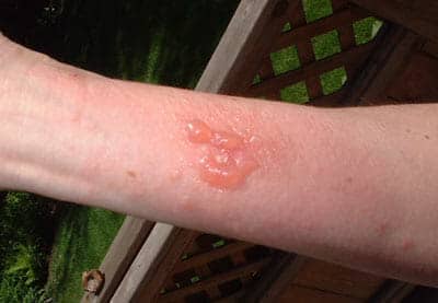 Moderately Severe Rash