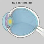 Nuclear cataract