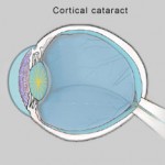 Cortical cataract