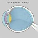 Subcapsular cataract