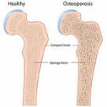 Healthy bone and bone with osteoporosis