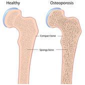 osteoporosis_awareness_2