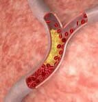 Cholesterol in veins