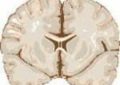 Meningitis