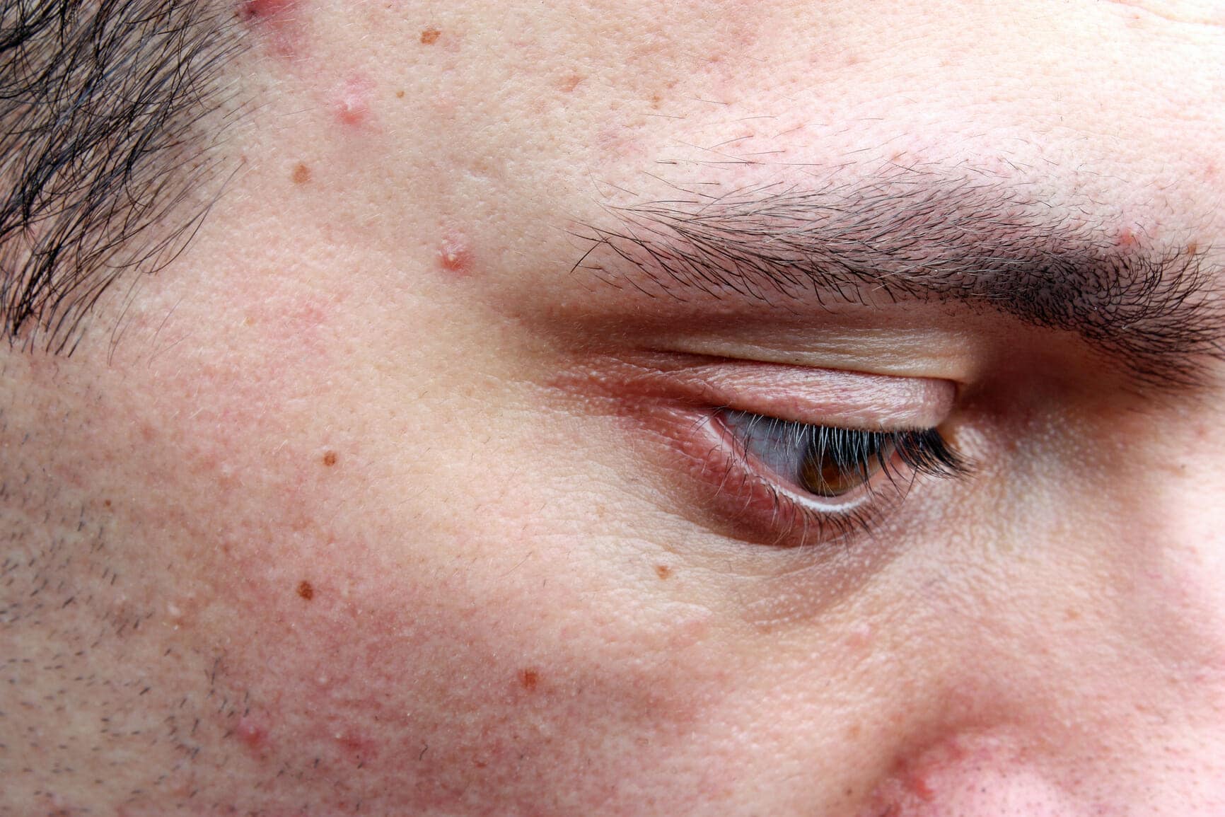 Skin Conditions: Acne HealthStatus Skin Conditions: Acne HealthStatus