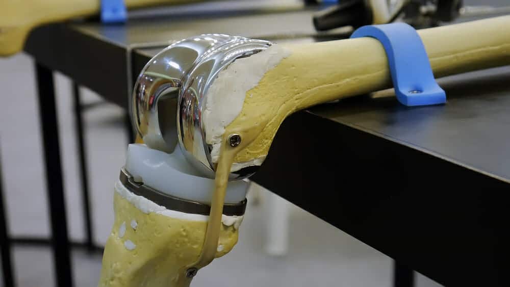 Total Knee Replacement Surgery HealthStatus