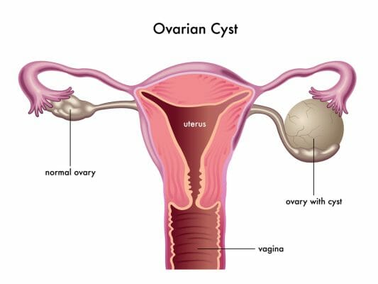 What Are the Symptoms of Ovarian Cysts? | HealthStatus
