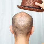 thin-hair-hat