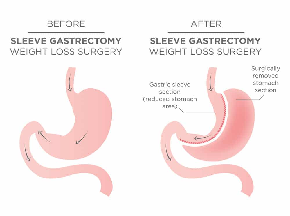 1200 calorie diet weight loss calculator after gastric sleeve