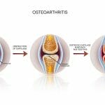 Osteoarthritis