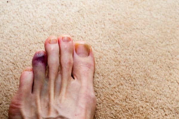 Broken Toe: Symptoms, Causes, Diagnosis, Treatment, and More - wide 11