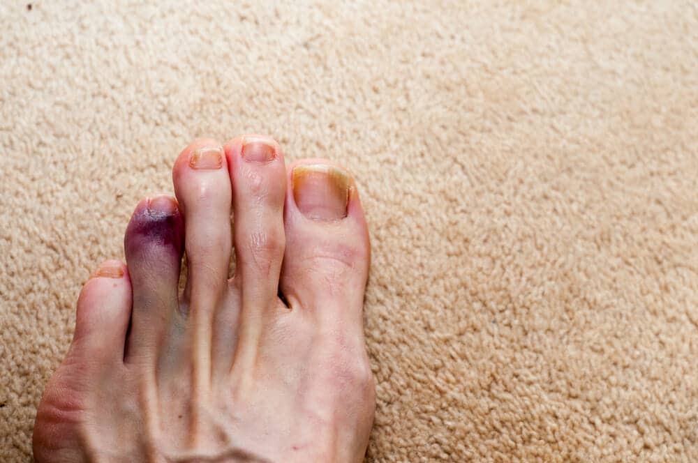 Broken Toe: Symptoms, Treatment, and Recovery Time - wide 2