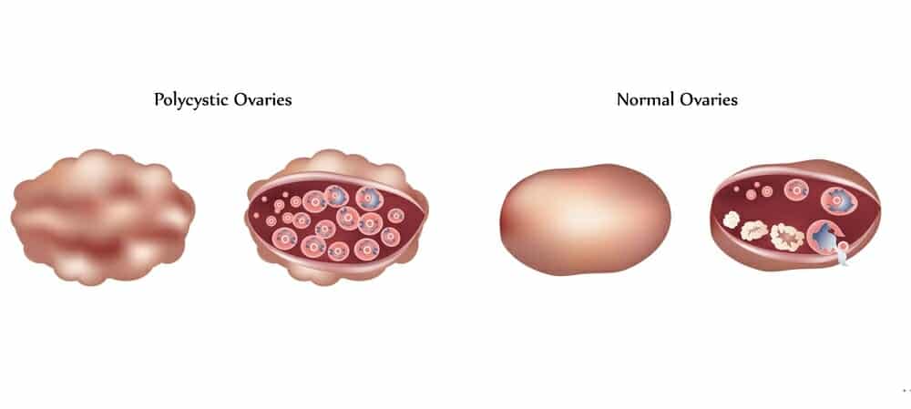 an introduction to the issue of polycystic ovarian syndrome pcos an introduction to the issue of polycystic ovarian syndrome pcos