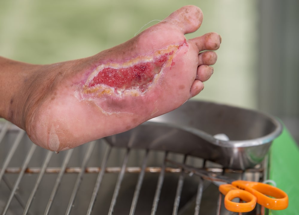 diabetes foot infection, DM patient have wound at arch of foot and chronic infection