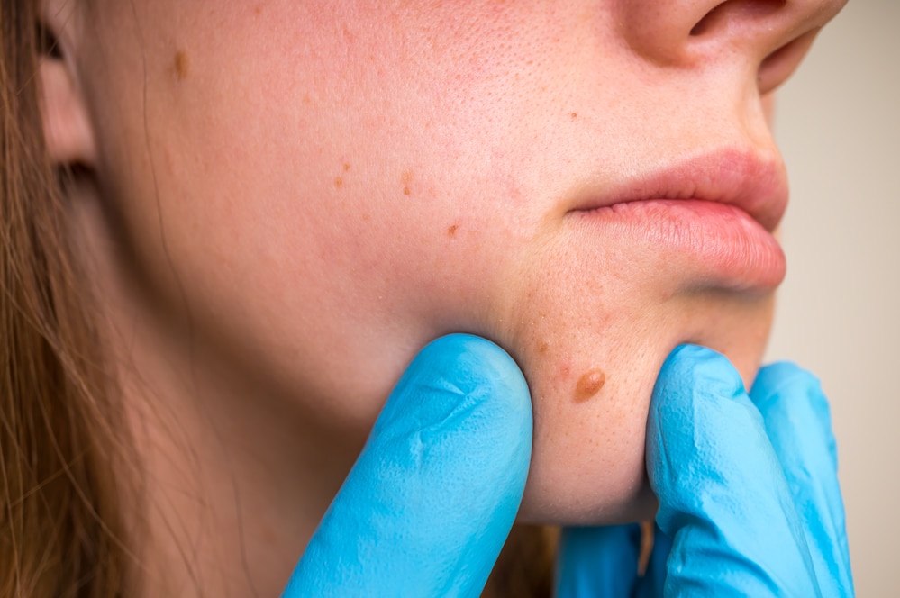 Why Do I Have Skin Tags HealthStatus how-to-use-tags-in-shopify-nexusmedia