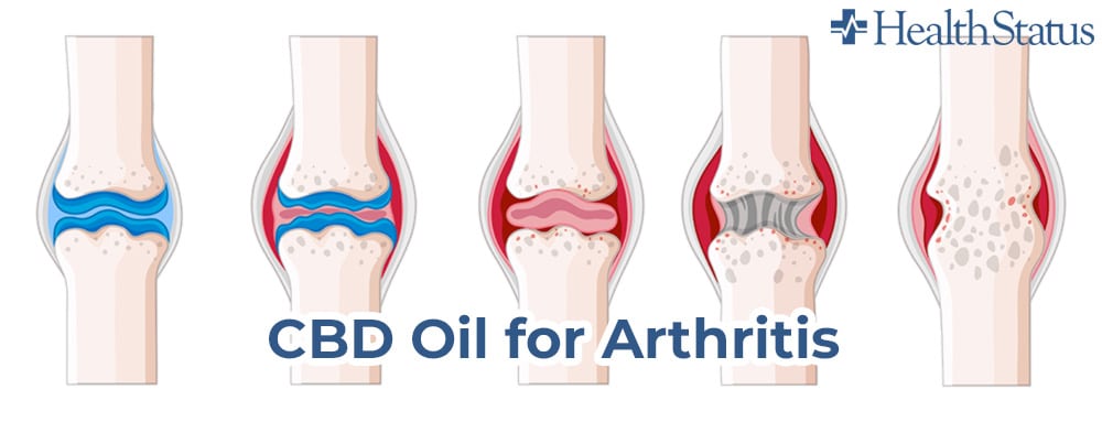 osteoarthritis kezelésére szolgáló tabletták