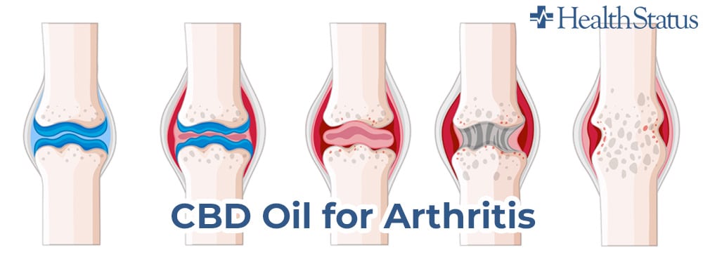 CBD Oil for Arthritis