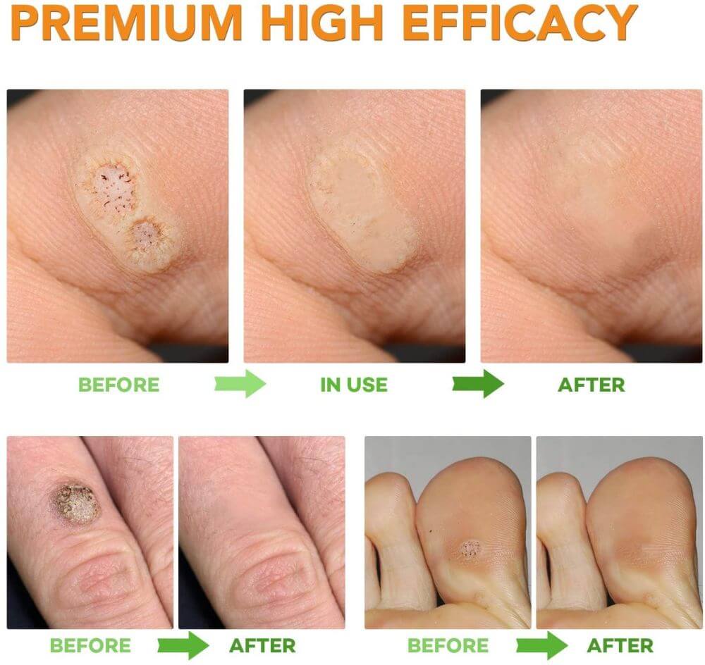 Our Wart Remover reviews and ratings (1)