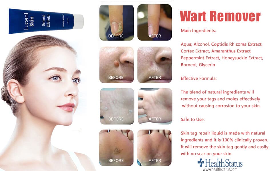 Wart Remover before after