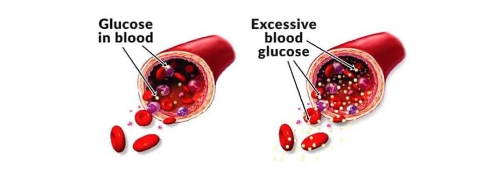 How does Glucofort work? How good is the effect of the Glucofort?