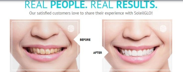 Idol White - Teeth Whitening