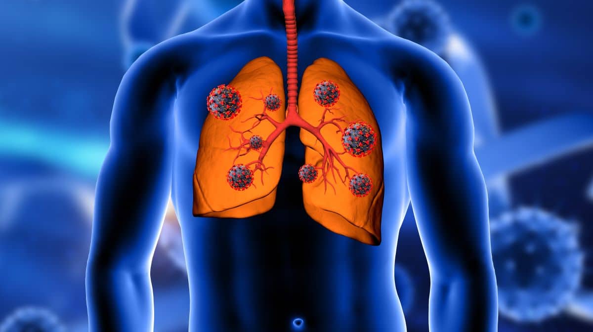 3D illustration of lungs affected by harmful particles representing asbestos exposure